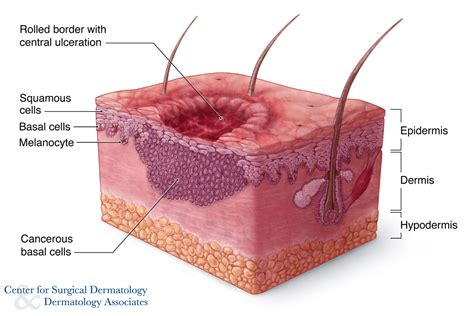 identifying  types  basal cell carcinoma center  surgical dermatology