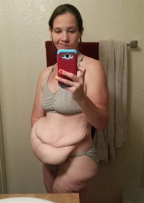 Obese Mum Undergoes Extreme Weight Loss Transformation