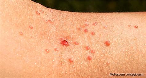 hiv rash types related symptoms and treatment