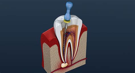 root canal specialist london root canal treatment harley street