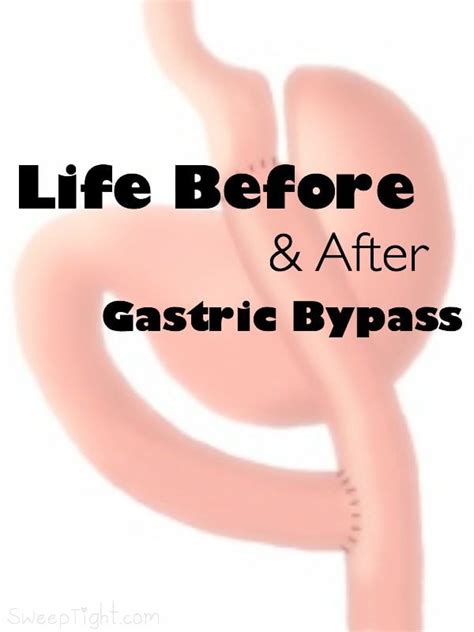Life Before And After Gastric Bypass A Magical Mess