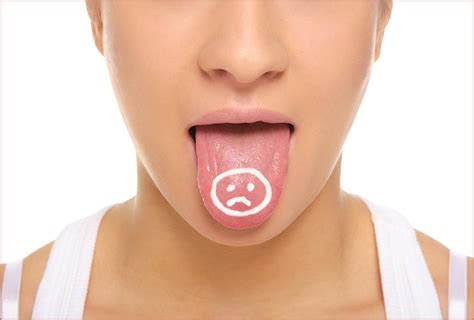 swollen tongue  hypothyroidism oral yeast infections