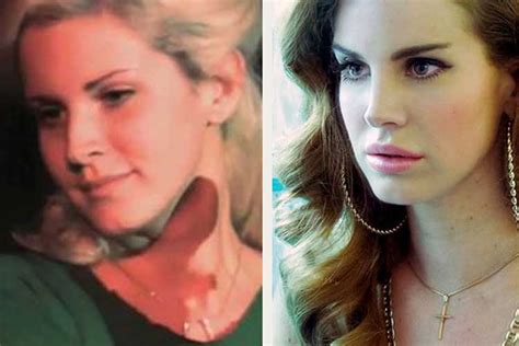 Lana Del Rey Plastic Surgery Lip Filler Nose Job Breast