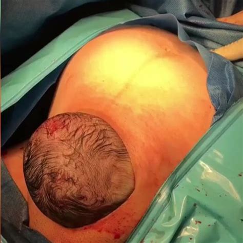 newborn s head pops out of mum s stomach during natural cesarean