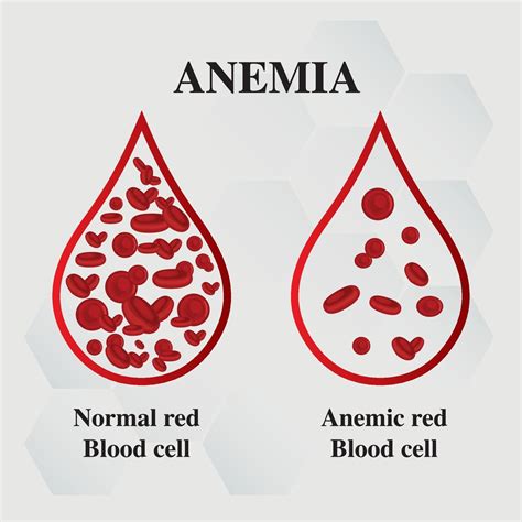 deficiency clipart png images red blood iron deficiency anemia hot