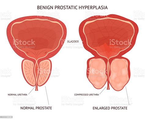 Cartoon Benign Prostatic Hyperplasia Infographics Concept Card Poster