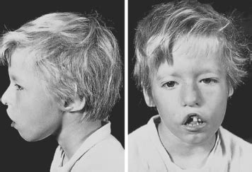 digeorge syndrome clinical gate