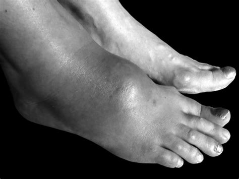 rare   foot swelling mimicking tenosynovitis  journal  rheumatology