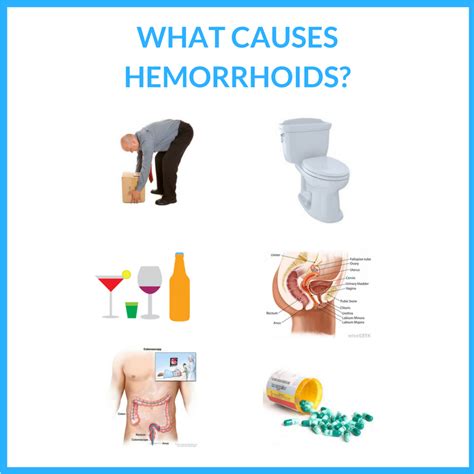 hemorrhoid causes guide 101 discover what causes hemorrhoids and how