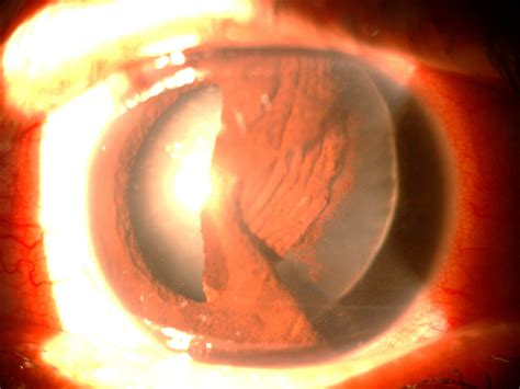 Complex Anterior Segment Surgery Eagle Eye Centre