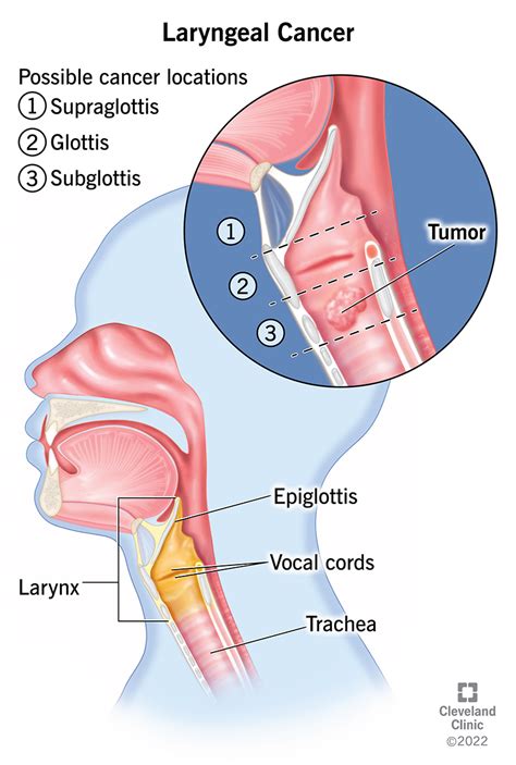 laryngeal cancer symptoms  treatment