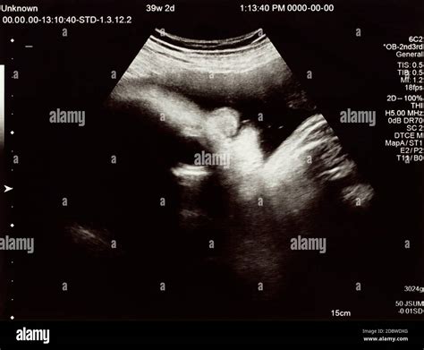 fetal ultrasound fotos und bildmaterial  hoher aufloesung alamy