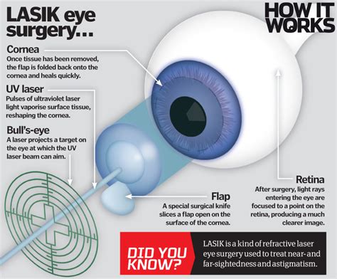 laser eye surgery work   works magazine