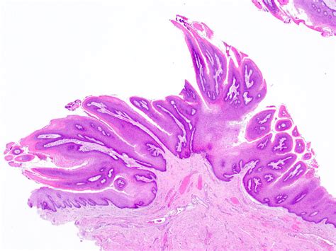 pathology outlines squamous papilloma