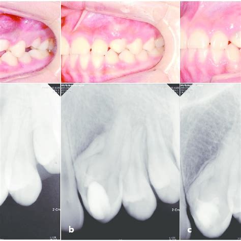 Pdf Pulp Revascularization Of A Severely Malformed Immature Maxillary