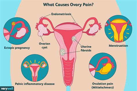 douleurs des ovaires  traitement  quand consulter  medecin