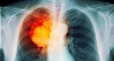 Lung Cancer Pictures X Rays Of Tumors Screening Symptoms And More