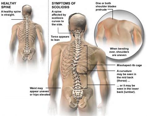 neuromuscular scoliosis a result of abnormal muscles or