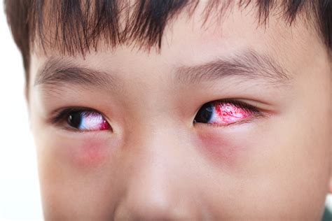 symptoms  pink eye getcaremd