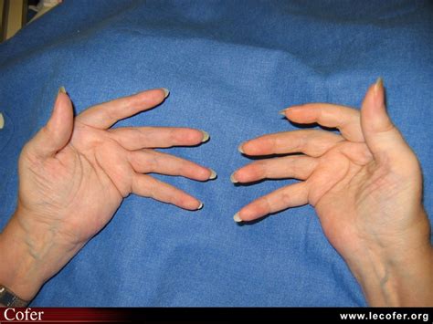 polyarthrite rhumatoide pr atteinte des doigts les deformations