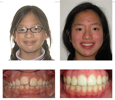 Before And After Bellevue Wa Dentist