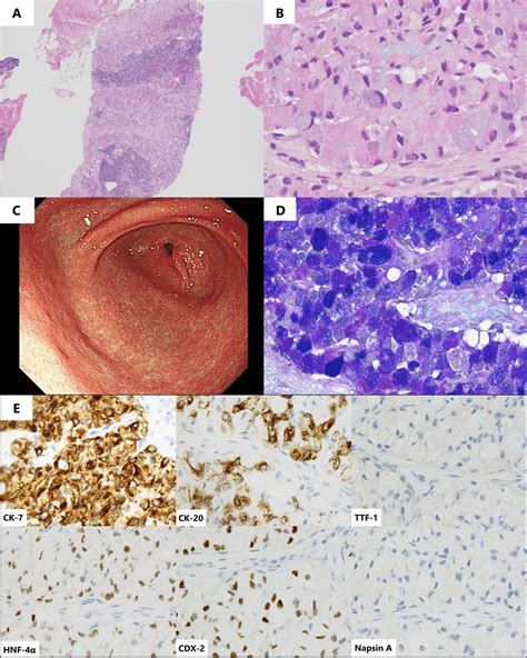 Pathological Findings Of Right Cervical Lymph Node Biopsy A