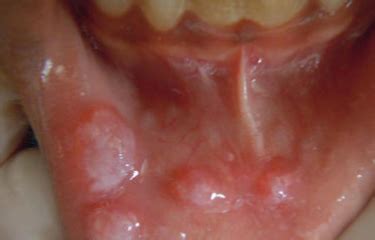 bump  mouth  cheek  tongue  lip white hard  rid treatment
