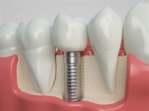 The Three Types Of Dental Implants Merrifield Dental Associates