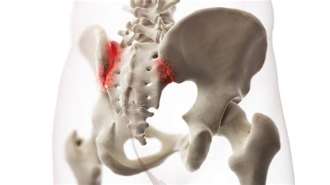 hip pain  sacroiliac joint dysfunction
