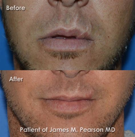 lip reconstructive surgery     dr james
