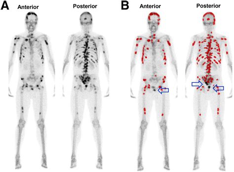 Analytic Validation Of The Automated Bone Scan Index As An