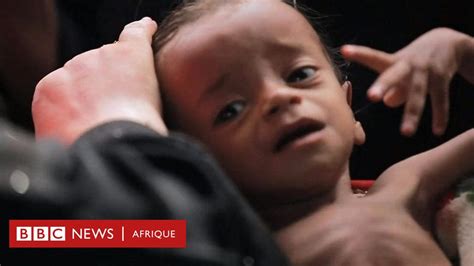 Au Yémen Les Ravages Du Choléra Bbc News Afrique