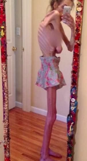 Woman Reveals Her 16 Year Battle With Anorexia And How It Started