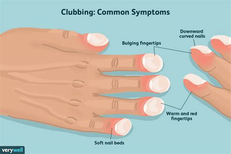 clubbed fingers and nails causes and what they look like