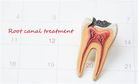 root canal procedure  performs      cost