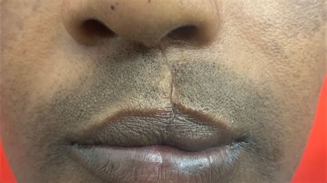 upper lip cleft revision plastic surgery video  remove scar increase thickness  south india