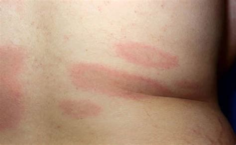 Lyme Disease Rash Causes Symptoms Diagnosis And Treatment