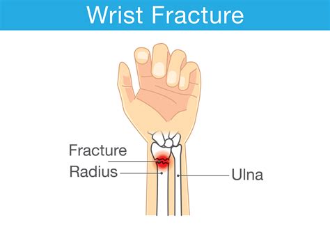 fractured wrist  aid wiki