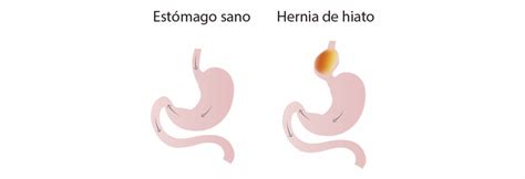 hernia hiatal ¿qué es causas síntomas y tratamiento centro medici