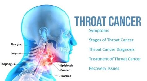 Throat Cancer Causes Symptoms And Effective Homeopathic