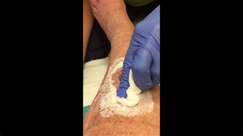 cleaning  wound youtube