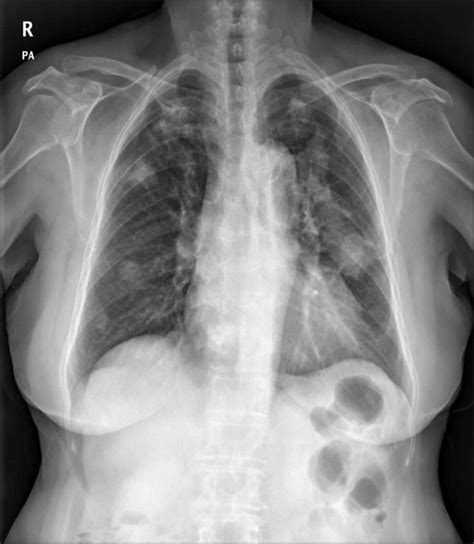 Simple Chest Radiograph Shows A Large Irregular Mass Like Lesion In The