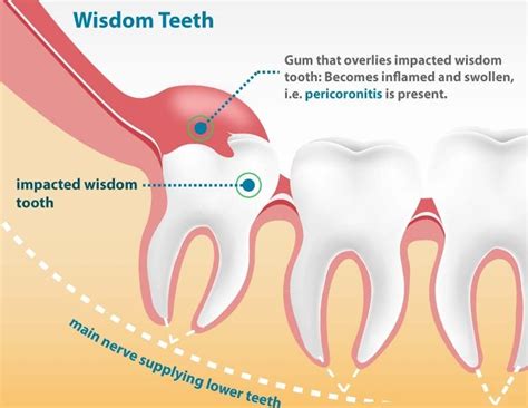 wisdom tooth surgery   prepare