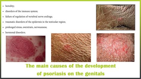 Causes Psoriasis Genitals Psoriasis Expert