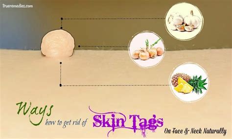 30 ways how to get rid of skin tags on face and neck