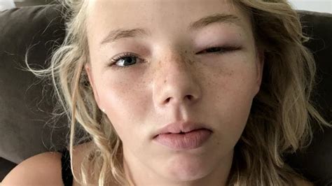 kmart eye mask ‘blinds teen with allergic reaction the advertiser