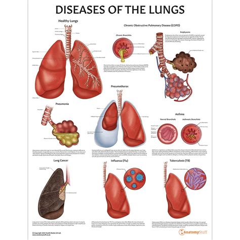 diseases   lungs chart anatomystuff