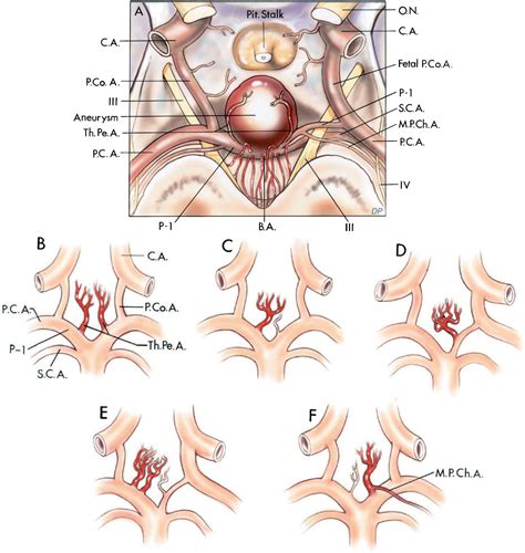 aneurysms  neurosurgical atlas