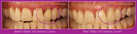ceramic crowns  dental care cosmetic dentists  dalry kilbirnie  beith