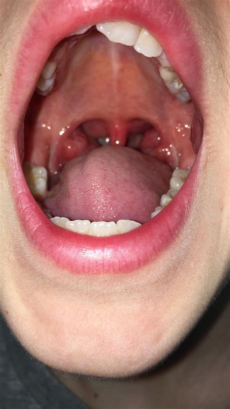 Adenoids And Tonsils — Louisa Ferguson Frcs
